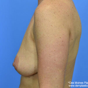 Breast Lift with Augmentation before and after photos