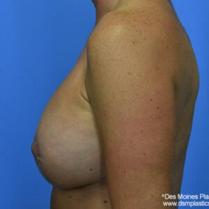 Breast Lift with Augmentation before and after photos