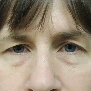 Eyelid Surgery before and after photos