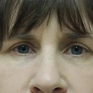 Eyelid Surgery before and after photos