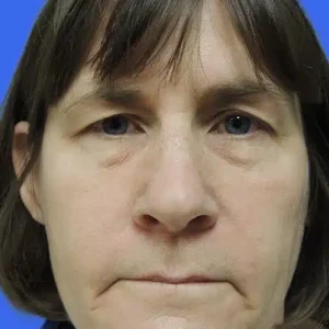 Eyelid Surgery before and after photos