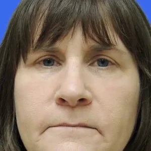 Eyelid Surgery before and after photos