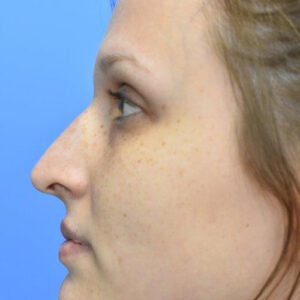 Rhinoplasty before and after photos