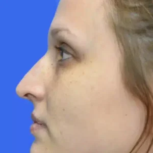 Rhinoplasty before and after photos
