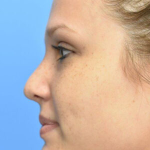 Rhinoplasty before and after photos