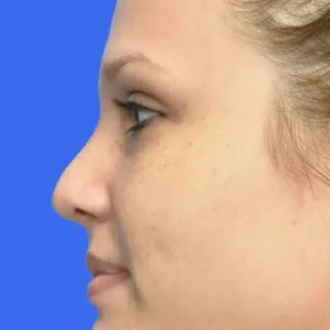 Rhinoplasty before and after photos