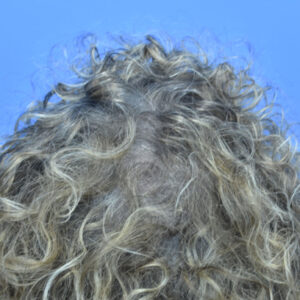 PRP Hair Loss Replacement before and after photos