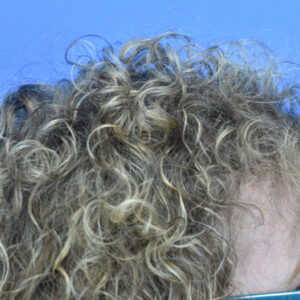 PRP Hair Loss Replacement before and after photos