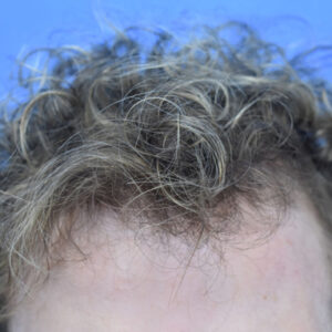 PRP Hair Loss Replacement before and after photos