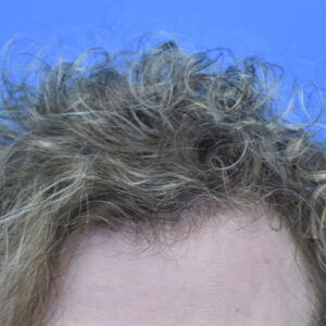 PRP Hair Loss Replacement before and after photos