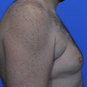 Male Breast Reduction before and after photos