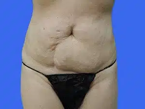 Tummy Tuck before and after photos Tummy Tuck before and after photos