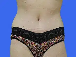 Tummy Tuck before and after photos Tummy Tuck before and after photos