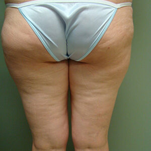 Liposuction before and after photos