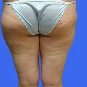 Liposuction before and after photos Liposuction before and after photos
