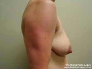 Breast Lift before and after photos