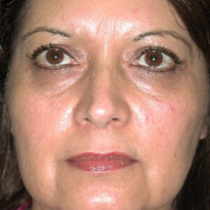 Face Lift before and after photos