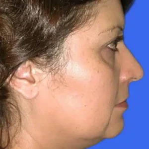 Face Lift before and after photos