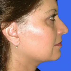 Face Lift before and after photos