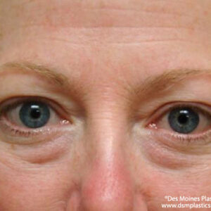 Eyelid Surgery before and after photos