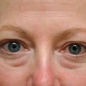 Eyelid Surgery before and after photos
