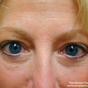 Eyelid Surgery before and after photos