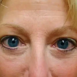Eyelid Surgery before and after photos