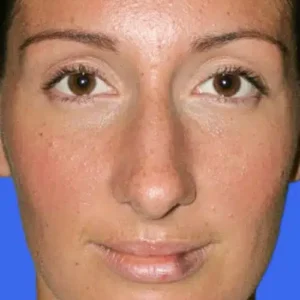 Rhinoplasty before and after photos