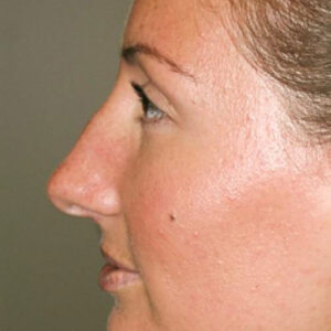 Rhinoplasty before and after photos