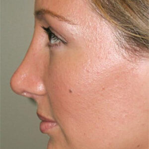 Rhinoplasty before and after photos