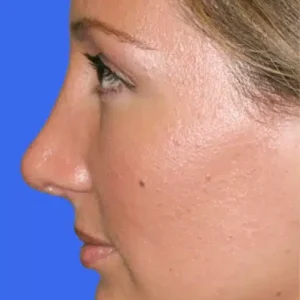 Rhinoplasty before and after photos