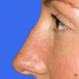 Rhinoplasty before and after photos