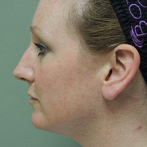 Laser Lift before and after photos