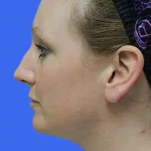 Laser Lift before and after photos