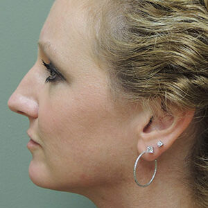 Laser Lift before and after photos