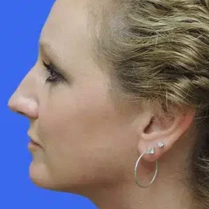 Laser Lift before and after photos