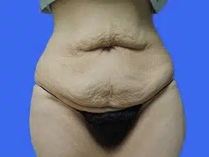 Tummy Tuck before and after photos Tummy Tuck before and after photos