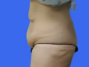 Tummy Tuck before and after photos Tummy Tuck before and after photos