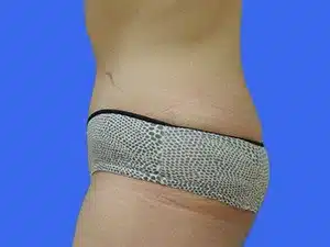 Tummy Tuck before and after photos Tummy Tuck before and after photos