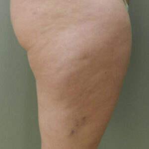 Liposuction before and after photos