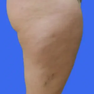 Liposuction before and after photos Liposuction before and after photos