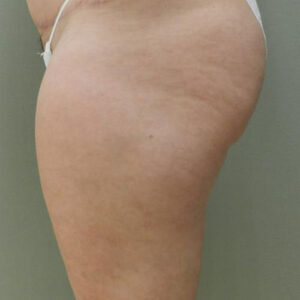 Liposuction before and after photos