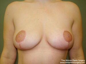 Breast Lift before and after photos