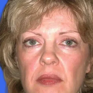 Face Lift before and after photos