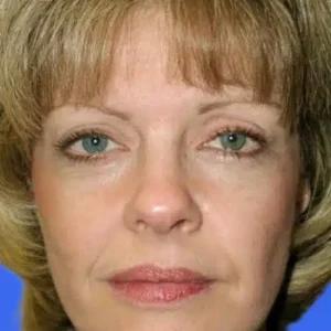 Face Lift before and after photos