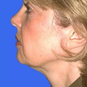 Face Lift before and after photos