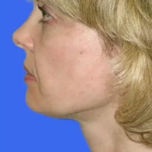 Face Lift before and after photos