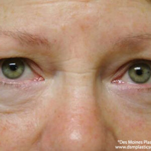 Eyelid Surgery before and after photos