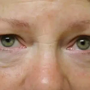 Eyelid Surgery before and after photos