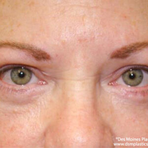 Eyelid Surgery before and after photos